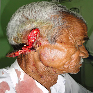  Ear Surgery