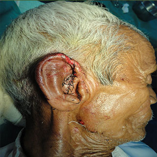  Ear Surgery