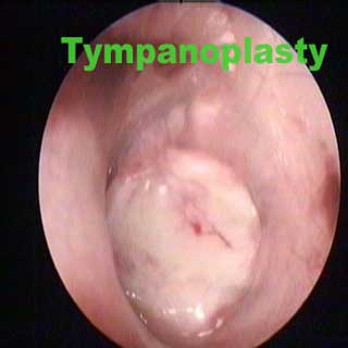  Ear Surgery