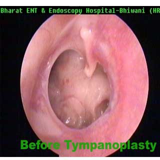  Ear Surgery