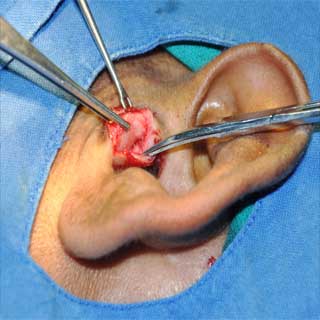  Ear Surgery