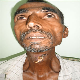  Laryngectomy Surgery