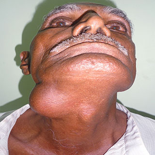  Thyroidectomy Surgery