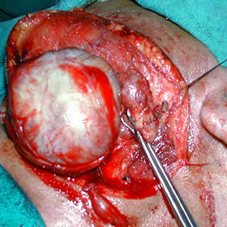  Thyroidectomy Surgery