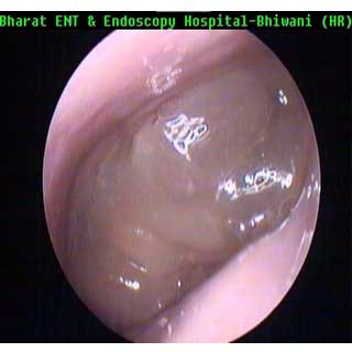  Ear Surgery