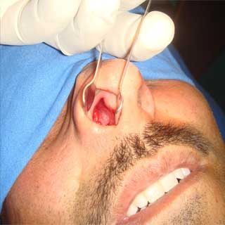  Ear Surgery