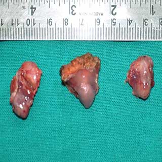  Thyroidectomy Surgery