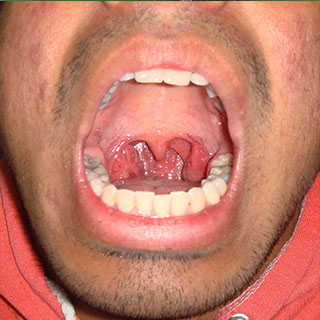  Laryngoscopic Surgery