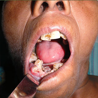  Laryngoscopic Surgery